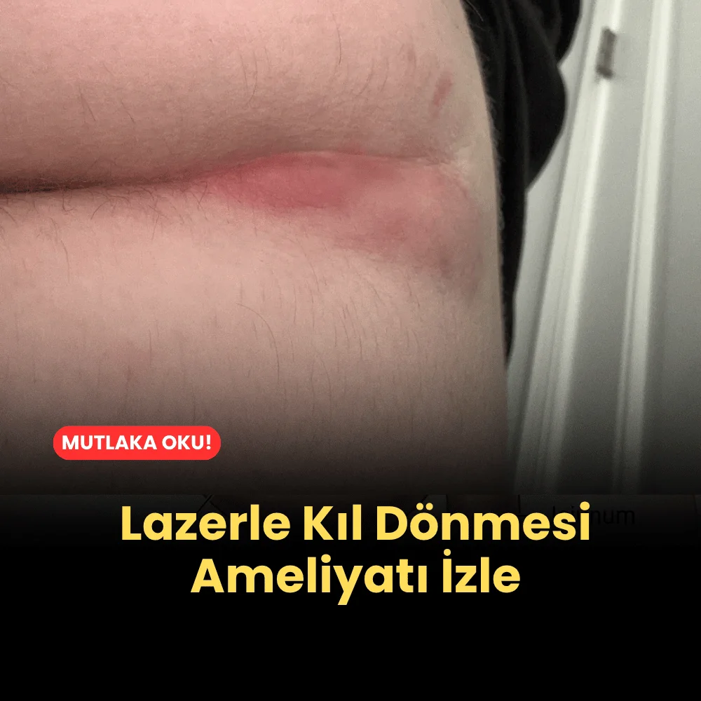Lazerle Kıl Dönmesi Ameliyatı İzle